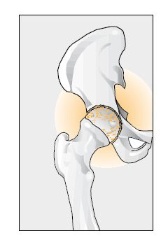 Artróza bedrového kĺbu